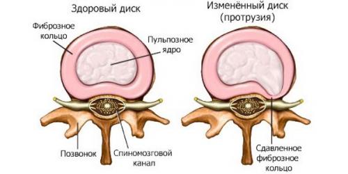 Хруст суставов, как лечить. Существует ли повод для беспокойства 03 Хруст суставов, как лечить. Существует ли повод для беспокойства 03