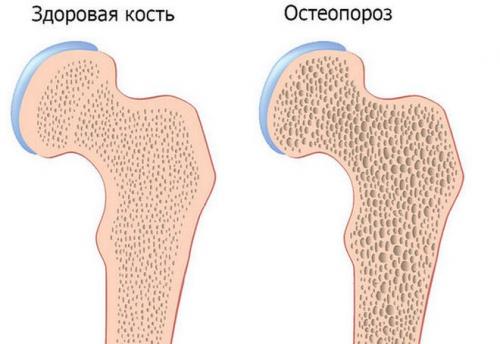 Как избавиться от хруста в коленях. Почему хрустят колени и что с этим делать?
