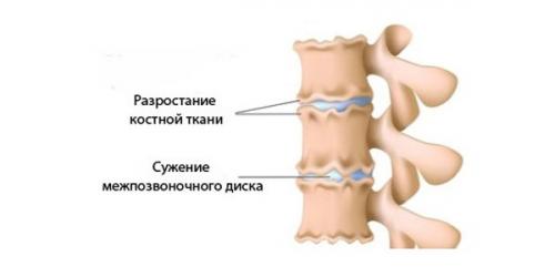 Хруст суставов, как лечить. Существует ли повод для беспокойства 02 Хруст суставов, как лечить. Существует ли повод для беспокойства 02
