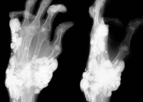 Отложение солей в локтевом суставе. Как лечить отложение солей в суставах?