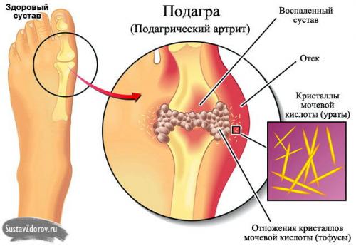 Отложение солей коленных суставах. Как лечить отложение солей в коленях?