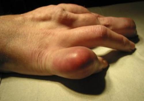 Отложение солей в локтевом суставе. Как лечить отложение солей в суставах?