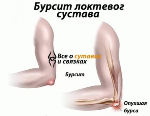 Шишка на суставе пальца руки под кожей твердая. Причины нарушения 02 Шишка на суставе пальца руки под кожей твердая. Причины нарушения 02