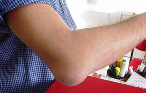 Шишка на суставе пальца руки под кожей твердая. Причины нарушения 04 Шишка на суставе пальца руки под кожей твердая. Причины нарушения 04