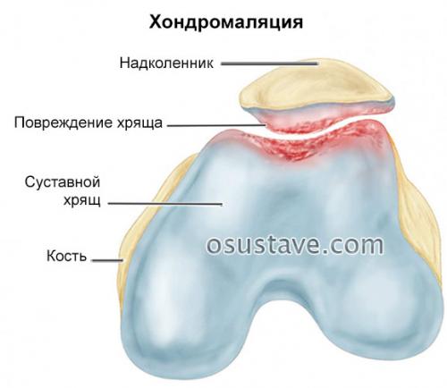 Медиальная фасетка надколенника на картинке