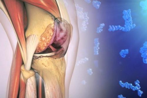 Повреждение связок коленного сустава срок восстановления. Повреждение связок коленного сустава