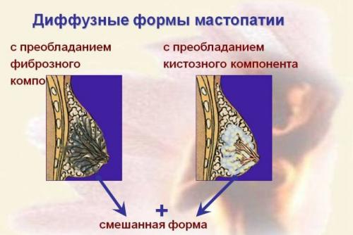 Джес при фиброзно кистозной мастопатии. Формы и виды мастопатии