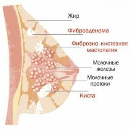 Фиброзно-кистозная мастопатия лечение. Классификация мастопатии молочной железы