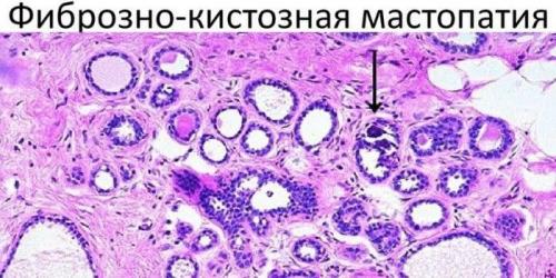 Джес при фиброзно кистозной мастопатии. Формы и виды мастопатии