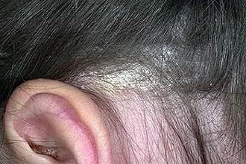 Шелушатся и чешутся уши снаружи. Аллергический контактный дерматит 01 Шелушатся и чешутся уши снаружи. Аллергический контактный дерматит 01