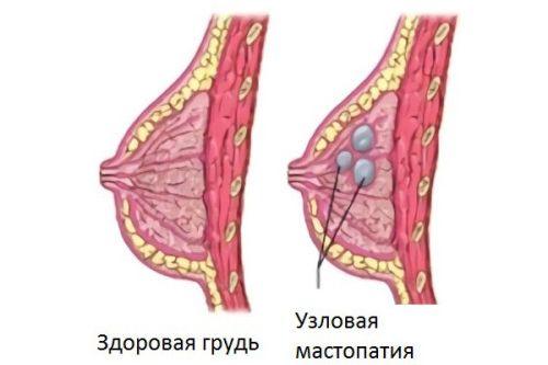 Джес при фиброзно кистозной мастопатии. Формы и виды мастопатии