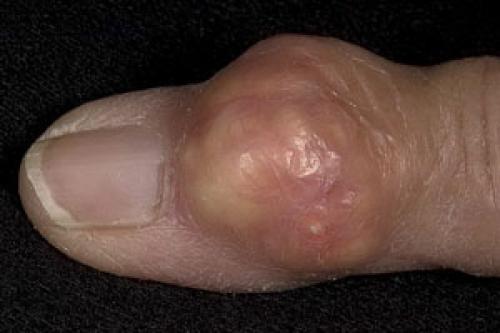 Отложение солей на пальцах рук. Основные причины