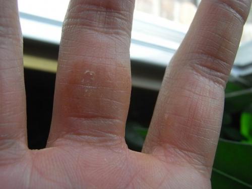 Нарост на пальце руки, как мозоль. Причины возникновения