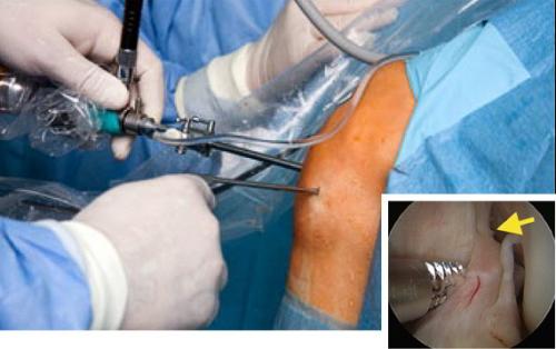 Лечение при разрыве мениска коленного сустава. Причины возникновения травмированности 04