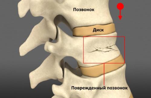 Компрессионный перелом сустава. Виды 05 Компрессионный перелом сустава. Виды 05