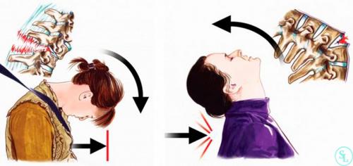 Компрессионный перелом позвоночника последствия. Виды переломов позвоночника
