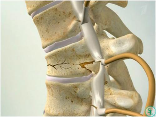 Компрессионный перелом сустава. Виды
