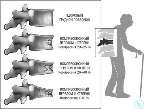Компрессионный перелом позвоночника последствия. Виды переломов позвоночника