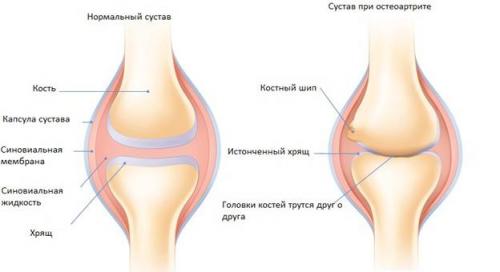 Что делать, чтобы не болели суставы? (полезно всем!)