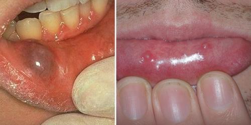 Бугорок верхней губы. Шишка на внутренней стороне губы