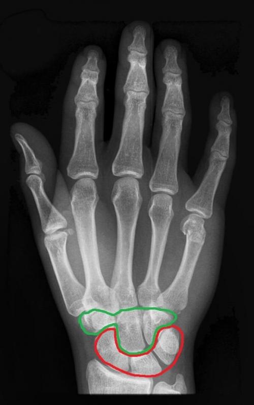 Анатомия кисти сухожилия. Анатомия кисти. Строение костей кисти.