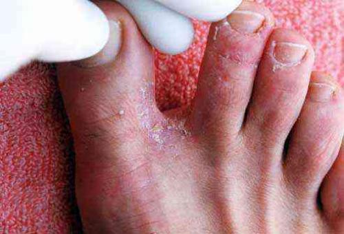 У ребенка между пальцами ног облазит кожа. Почему облазит кожа на пальцах ног и между пальцами