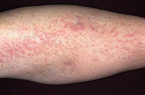 На пальцах ног кожа отслаивается. Причины 02