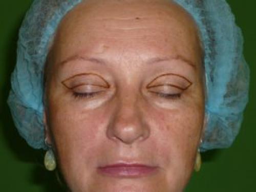 Опухшие глаза после блефаропластики. Отеки после блефаропластики: причины возникновения и способы устранения недуга