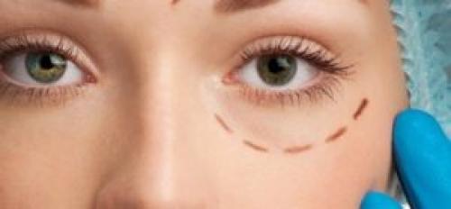 Опухшие глаза после блефаропластики. Отеки после блефаропластики: причины возникновения и способы устранения недуга