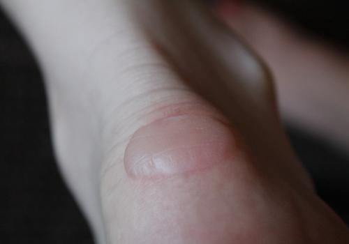 Мазь от влажных мозолей. Мокрая или водяная мозоль.