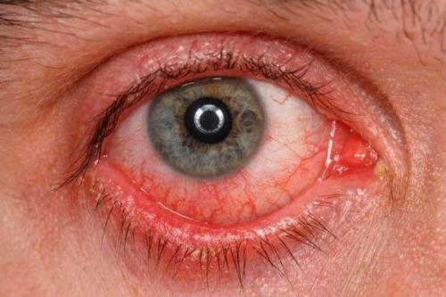 Отечность и покраснение вокруг глаз. Почему веки краснеют?