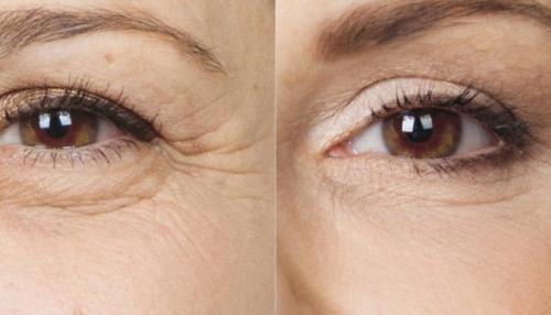 Опухшие глаза после блефаропластики. Отеки после блефаропластики: причины возникновения и способы устранения недуга