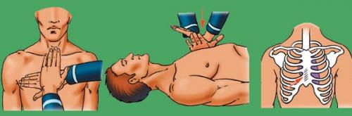 Непрямой массаж сердца. Техника проведения непрямого массажа сердца и искусственной вентиляции легких