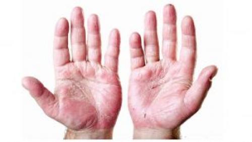 Кожа на подушечках пальцев рук шелушится. Почему шелушится кожа на пальцах рук?