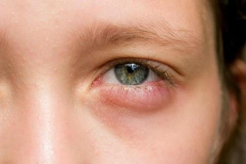 Как избавиться от опухших глаз после сна. Почему по утрам опухают веки