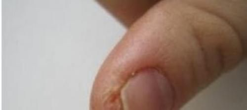 На подушечках пальцев трескается кожа. Ищем причину появления трещинок