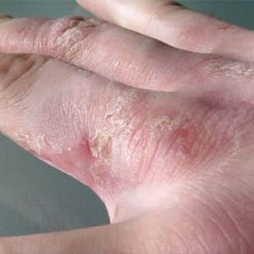 Крем для рук от шелушения. Причины