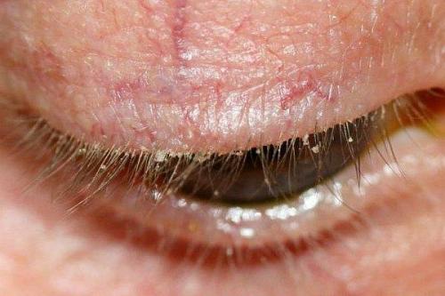 Отечность и покраснение вокруг глаз. Почему веки краснеют?