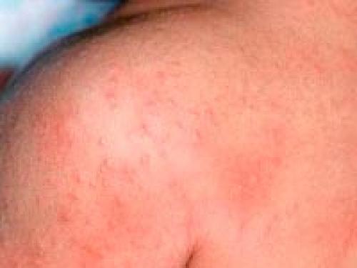 Как лечить запущенный грибок ногтей на ногах. Как вылечить запущенный грибок ногтей на ногах?