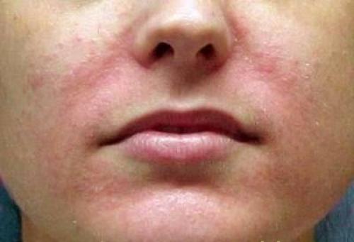 Крем от зуда кожи. Противозудные препараты в дерматологии 03 Крем от зуда кожи. Противозудные препараты в дерматологии 03