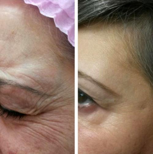 Косметологические процедуры для лица после 50 лет. Инъекционные методы