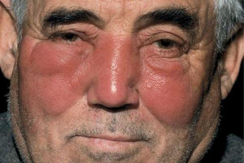 Отечность и покраснение вокруг глаз. Почему веки краснеют?