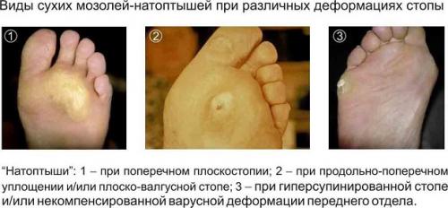 Стержневая мозоль на пальце ноги. Мозоль со стержнем — лечение патологии