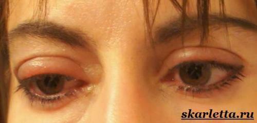 Как избавиться от опухших глаз после слез. Отеки глаз после слез. Почему появляются и как избавиться