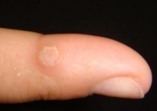 Как вылечить мозоль на пальце. Причины образования мозолей на пальце руки