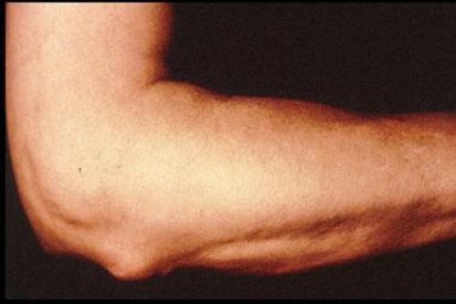 Уплотнения в. Какую угрозу несет в себе уплотнение под кожей? 01