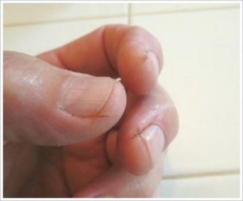 Трескается кожа на пальцах рук возле ногтей. Внутренние факторы