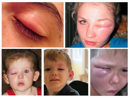 Покраснение под глазом и отек. Полезное видео