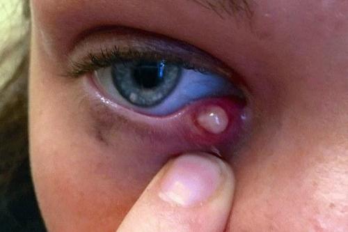 Отечность и покраснение вокруг глаз. Почему веки краснеют?