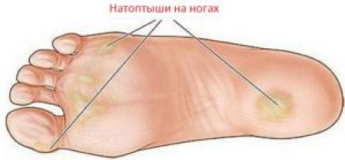 Мазь вишневского от натоптышей. Подготовка кожи к нанесению мази